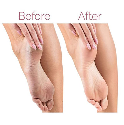 Electric Pedicure Foot File Callus Remover - Layzon